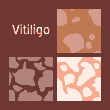 Vitiligo deri hastalığı. Kusursuz vektör deseni. Kendini sevme günün kutlu olsun. Çizgi film karalama tarzında Sağlık Sancağı konsepti. Vücudunun, yüzünün, elinin.