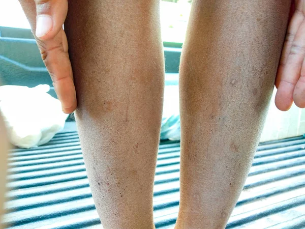 Baby leg, broken skin, dry, concept  Dermatitis, eczema, ringworm  cream lotion cosmetic