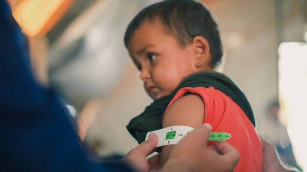 Врач исследует недоедание детей в лагере беженцев. Недоедание было измерено с помощью среднего пояса окружности плеча.