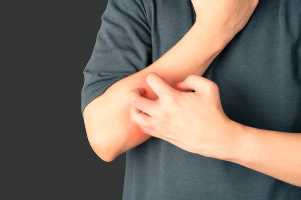 男は暗い背景にかゆみを持つことから腕を引っ掻く かゆみの原因は アトピー性皮膚炎 食品や薬アレルギーや乾燥肌が含まれています ヘルスケアの概念 — ストック写真