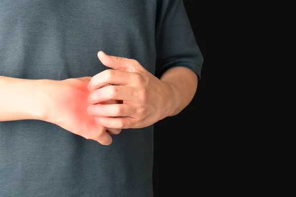 赤い発疹で彼の手にかゆみを掻いている男 かゆみの原因は アトピー性皮膚炎 食品や薬アレルギーや乾燥肌が含まれています 皮膚科の概念 — ストック写真