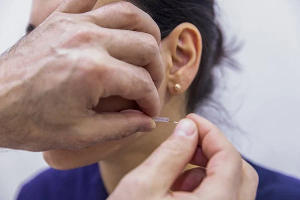 Dry needle treatment. A portrait of a small acupuncture needle sticking in a person\'s face next to the nose, to heal pain, relieve stress or another medical condition with alternative medicine.