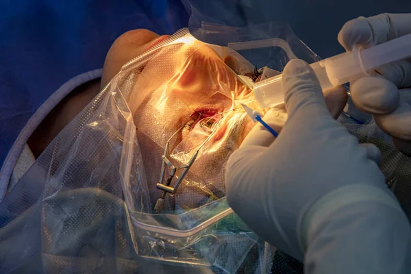 Laser vision correction. A patient and team of surgeons in the operating room during ophthalmic surgery. Patient under sterile lid.Ophthalmology surgery for eyes with laser correction for vision.