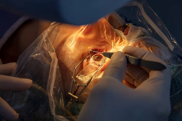 Laser vision correction. A patient and team of surgeons in the operating room during ophthalmic surgery. Patient under sterile lid.Ophthalmology surgery for eyes with laser correction for vision.