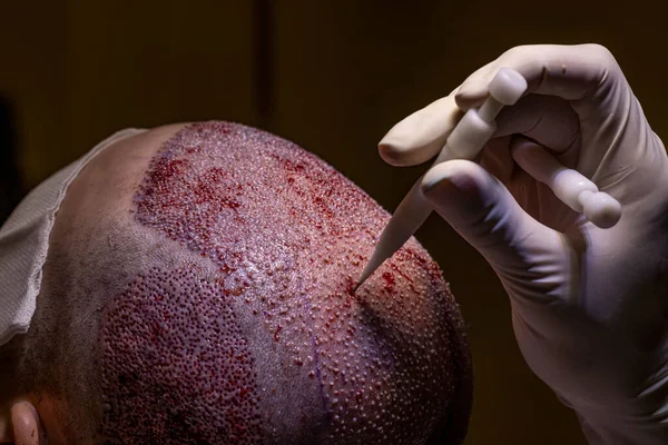 Hajátültetés Dhi Fue Rendszer Hajbeültetéses Beteg Műtét Után Sebészek Műtőben Stock Kép