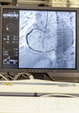 Kalp atardamarlarının sağlığını göstermek için arterlere (sol & ortada) yerleştirilen bir tüpten enjekte edilen bir kontrastlı madde ile saat yönünde çalışan anjiyogram dizisi.