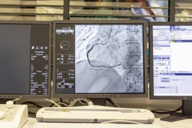 Kalp atardamarlarının sağlığını göstermek için arterlere (sol & ortada) yerleştirilen bir tüpten enjekte edilen bir kontrastlı madde ile saat yönünde çalışan anjiyogram dizisi.