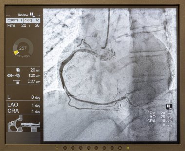 Angiogram sequence working clockwise using x-rays with a contrast agent injected from a tube inserted into the arteries (left & centre), to show the health of the coronary arteries. clipart