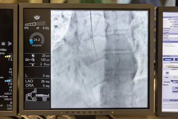Angiogram sequence working clockwise using x-rays with a contrast agent injected from a tube inserted into the arteries (left & centre), to show the health of the coronary arteries.
