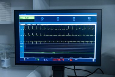 Modern ekipmanlar, modern kliniğin ameliyathanesinde hayati göstergelere sahip monitörler. Kardiyogram sinyal izleme işlemi. Hastanın hayati belirtileri ekranda gösteriliyor. EKG, EKG eğrileri.