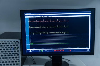 Modern ekipmanlar, modern kliniğin ameliyathanesinde hayati göstergelere sahip monitörler. Kardiyogram sinyal izleme işlemi. Hastanın hayati belirtileri ekranda gösteriliyor. EKG, EKG eğrileri.