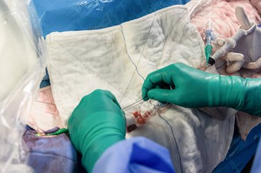 Ameliyathanede kalp stent yerleştirme işlemi. Kalp doktoru merkezi venöz kateter takıyor, şahdamarı kateterize ediyor. Şahdamarına merkezi venöz kateter yerleştiriliyor..