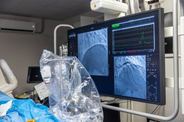 Denizli Türkiye-28 Şubat 2024; Doktorlar bir tanı operasyonu yürüttüler. Koronarografi. Perkütan koroner müdahale analizi, balon anjiyoplasti ve sol koroner arterin stenti..