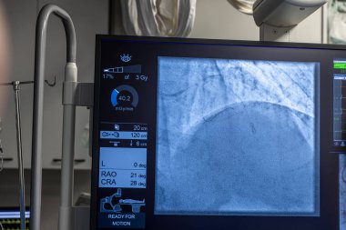 Denizli Türkiye-28 Şubat 2024; Doktorlar bir tanı operasyonu yürüttüler. Koronarografi. Perkütan koroner müdahale analizi, balon anjiyoplasti ve sol koroner arterin stenti..