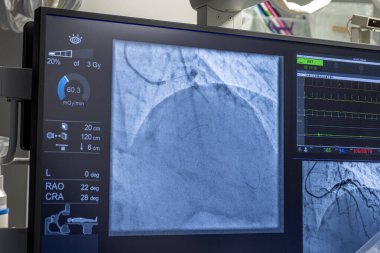 Denizli Türkiye-28 Şubat 2024; Doktorlar bir tanı operasyonu yürüttüler. Koronarografi. Perkütan koroner müdahale analizi, balon anjiyoplasti ve sol koroner arterin stenti..