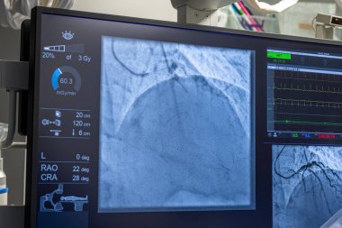 Denizli Turkey-28 February 2024; Doctors conduct a diagnostic operation.Coronarography.Percutaneous coronary intervention-recanalization, balloon angioplasty and stenting of the left coronary artery. clipart