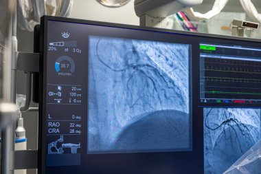 Denizli Türkiye-28 Şubat 2024; Doktorlar bir tanı operasyonu yürüttüler. Koronarografi. Perkütan koroner müdahale analizi, balon anjiyoplasti ve sol koroner arterin stenti..