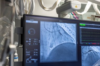 Denizli Türkiye-28 Şubat 2024; Doktorlar bir tanı operasyonu yürüttüler. Koronarografi. Perkütan koroner müdahale analizi, balon anjiyoplasti ve sol koroner arterin stenti..