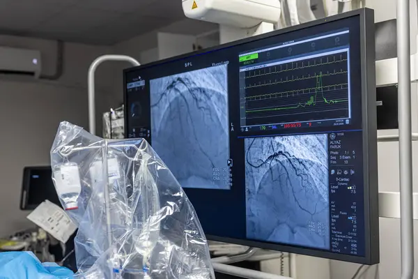 stock image Denizli Turkey-28 February 2024; Doctors conduct a diagnostic operation.Coronarography.Percutaneous coronary intervention-recanalization, balloon angioplasty and stenting of the left coronary artery.