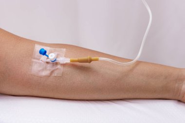 Hastanedeki hastalıktan kurtulması için damar içi serum verildiği sırada hastanın kolu. Tıp, sağlık ve insan kavramı.
