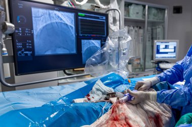 Denizli Türkiye-28 Şubat 2024; Doktorlar bir tanı operasyonu yürüttüler. Koronarografi. Perkütan koroner müdahale analizi, balon anjiyoplasti ve sol koroner arterin stenti..