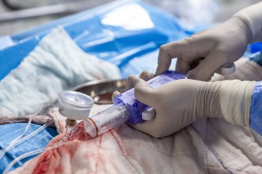 Ameliyathanede kalp stent yerleştirme işlemi. Kalp doktoru merkezi venöz kateter takıyor, şahdamarı kateterize ediyor. Şahdamarına merkezi venöz kateter yerleştiriliyor..