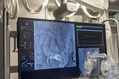 Istanbul, Turkey February 29, 2024; X-ray for valvular replacement with melody valve. View of prosthetic heart valve dysfunction in patient who has mitral valve replacement with mechanical valve. clipart