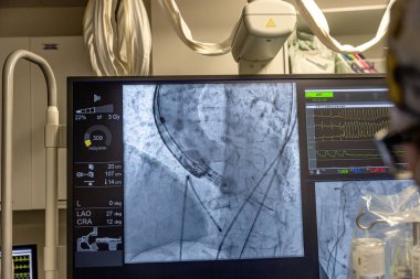 Istanbul, Turkey February 29, 2024; X-ray for valvular replacement with melody valve. View of prosthetic heart valve dysfunction in patient who has mitral valve replacement with mechanical valve. clipart