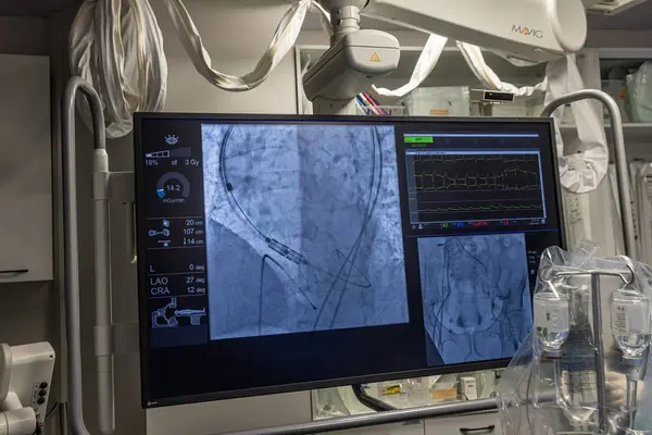 stock image Istanbul, Turkey February 29, 2024; X-ray for valvular replacement with melody valve. View of prosthetic heart valve dysfunction in patient who has mitral valve replacement with mechanical valve.