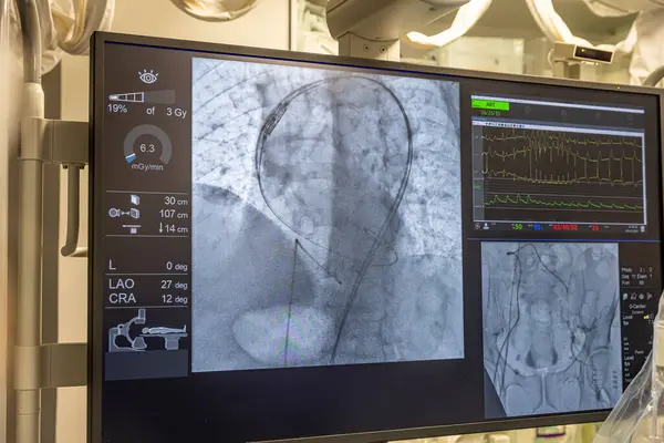 stock image Istanbul, Turkey February 29, 2024; X-ray for valvular replacement with melody valve. View of prosthetic heart valve dysfunction in patient who has mitral valve replacement with mechanical valve.