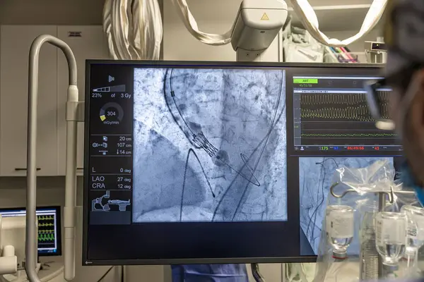 stock image Istanbul, Turkey February 29, 2024; X-ray for valvular replacement with melody valve. View of prosthetic heart valve dysfunction in patient who has mitral valve replacement with mechanical valve.