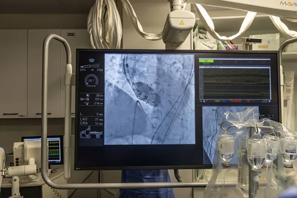 stock image Istanbul, Turkey February 29, 2024; X-ray for valvular replacement with melody valve. View of prosthetic heart valve dysfunction in patient who has mitral valve replacement with mechanical valve.