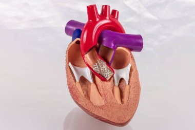 Halk eğitimi için Transkateter aort kapakçık implantasyonu (TAVI) kardiyak modeli. Kalp nakli ve ameliyat konsepti. İçini gösteren plastik insan kalbi modeli..