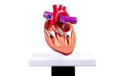 Halk eğitimi için Transkateter aort kapakçık implantasyonu (TAVI) kardiyak modeli. Kalp nakli ve ameliyat konsepti. İçini gösteren plastik insan kalbi modeli..