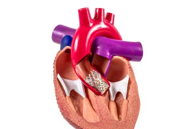 Cardiac model of Transcatheter aortic valve implantation (TAVI) for people education. Heart transplant and surgery concept, shunting. Plastic human heart model showing the interior. clipart