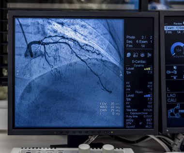 Istanbul, Turkey 28 February 2024; Angiogram sequence working clockwise using x-rays with a contrast agent injected from a tube inserted into the arteries, to show the health of the coronary arteries