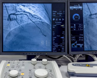 İstanbul, Türkiye 28 Şubat 2024; Koroner arterlerin sağlığını göstermek için arterlere yerleştirilen bir tüpten enjekte edilen kontrastlı bir madde ile saat yönünde çalışan anjiyogram dizisi