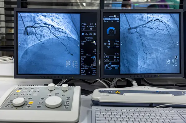 İstanbul, Türkiye 28 Şubat 2024; Koroner arterlerin sağlığını göstermek için arterlere yerleştirilen bir tüpten enjekte edilen kontrastlı bir madde ile saat yönünde çalışan anjiyogram dizisi