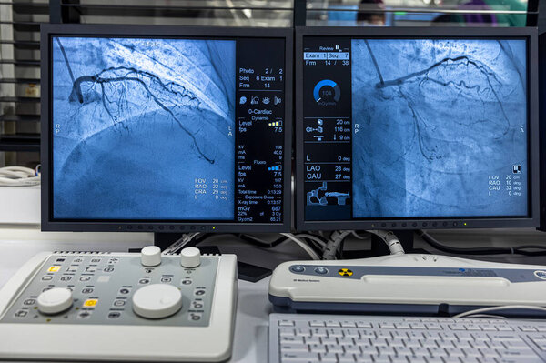 Стамбул, Турция 28 февраля 2024 года; Последовательность ангиограмм, работающих по часовой стрелке с помощью рентгеновских лучей с контрастным агентом, введенным из трубки, вставленной в артерии, чтобы показать здоровье коронарных артерий