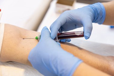Doktor ya da hemşire boş gezen biriyle kol damarından kan örneği alıyor. Venipunktur ya da venepunktur prosedürü. Laboratuvardaki bir hemşire damardan kan testi yaptırıyor. Yüzü olmayan yakın plan bir plan..