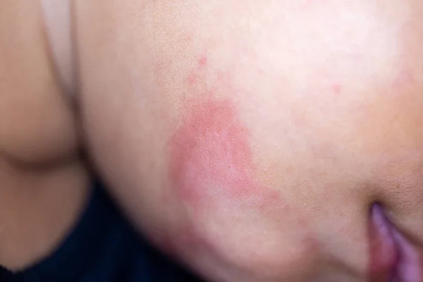 Una Dermatitis Pequeñas Protuberancias Verrugosas Aparecen Piel Niño — Foto de Stock