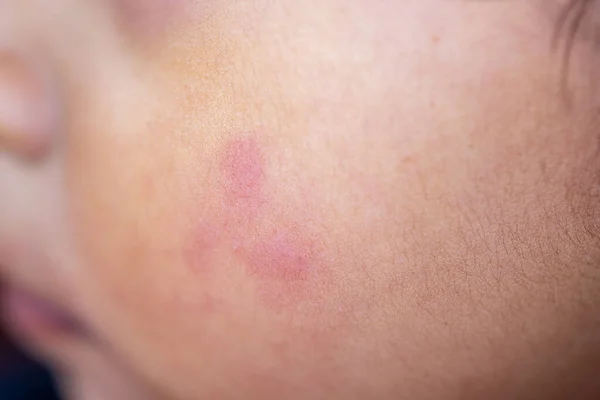 Uma Dermatite Pequenos Solavancos Verruga Aparecem Pele Criança — Fotografia de Stock