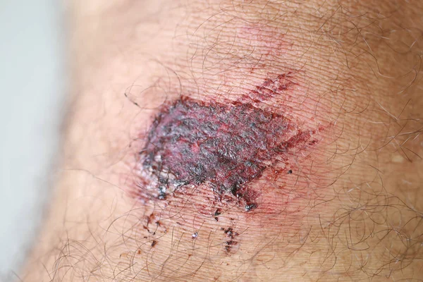 Ist Eine Dermatitis Kleine Warzige Beulen Erscheinen Auf Der Haut Stockbild