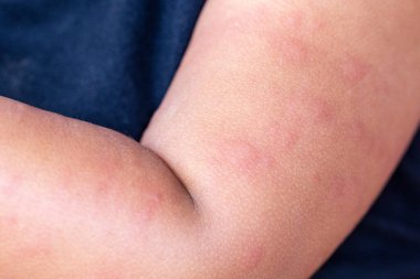 Bu bir dermatit küçük siğil şişlikleri çocukta görünür..