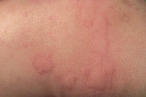 Dermatitis Small Warty Bumps Appear Skin Child — Stock Photo, Image