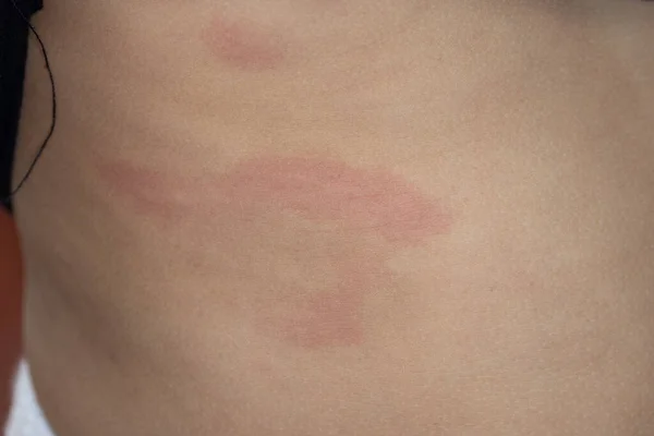 Dermatitis Small Warty Bumps Appear Skin Child — Stock Photo, Image