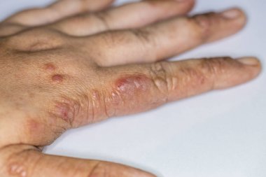 Background of human skin with Dust Mite Allergy.