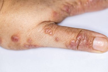 Background of human skin with Dust Mite Allergy.