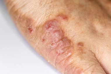 Background of human skin with Dust Mite Allergy.