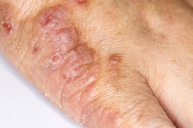 Background of human skin with Dust Mite Allergy.